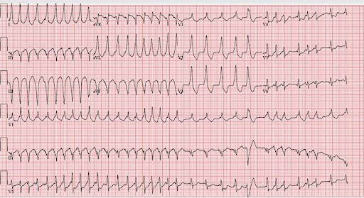 Figura 3 associada à fibrilação atrial. Confira! 