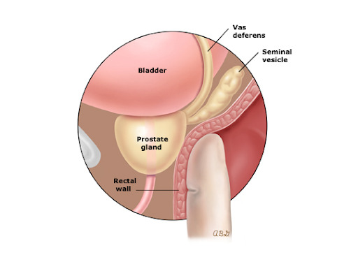 Confira uma figura do toque retal, atrelado à hiperplasia prostática benigna.