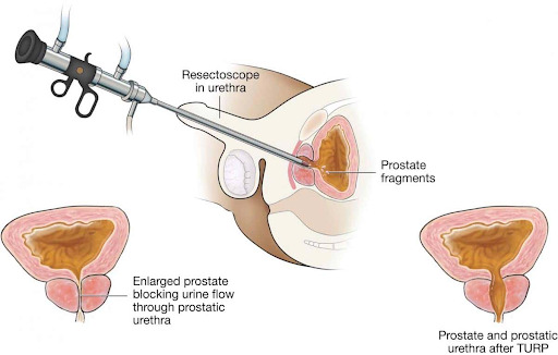 Confira a ressecção transuretral da próstata, atrelada à hiperplasia prostática benigna.