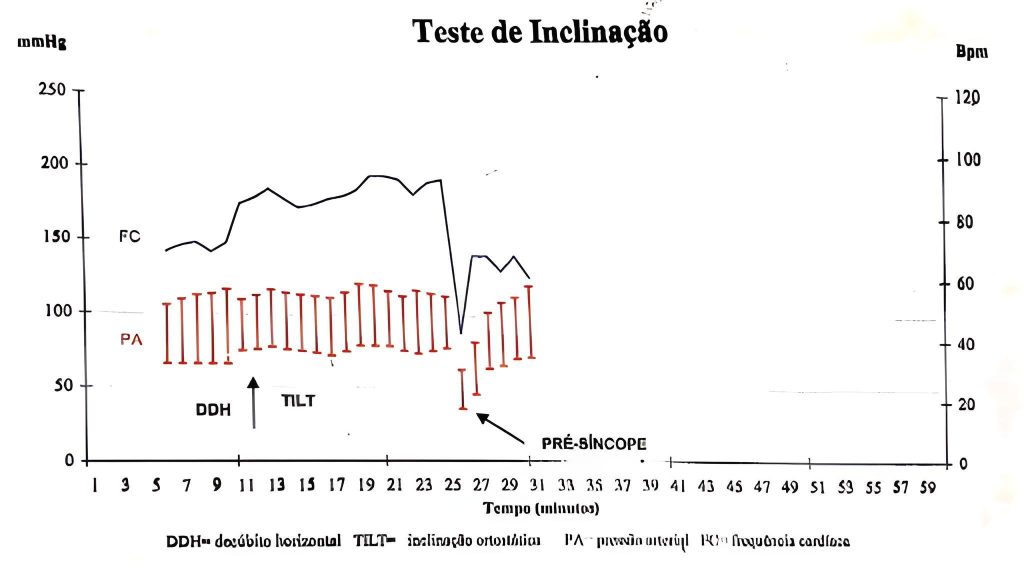 Liga Acadêmica de Cardiologia - LAC UNISC - O que é Tilt-test? O Teste de  Inclinação (TI) é um método muito utilizado para a investigação de síncope,  pré-síncopes, tonturas, palpitações relacionadas ao