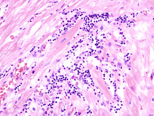 Figura 1. Imagem histopatológica de miocardite viral na autópsia em paciente com insuficiência cardíaca congestiva aguda. A etiologia viral, entretanto, não foi determinada no estudo sorológico.