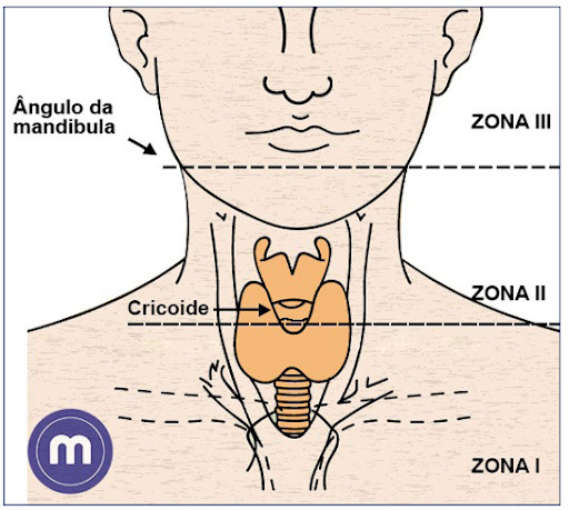 Figura 1: Zonas Anatômicas do Pescoço. Fonte: ROON & CHRISTIANSEN,1979 - The Journal of Trauma: Injury, Infection, and Critical Care: June 1979 - p 391-397.