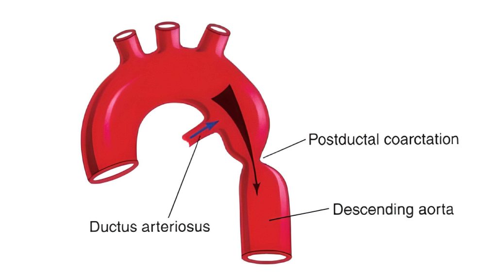 Coarctação de Aorta: achados na radiografia de tórax