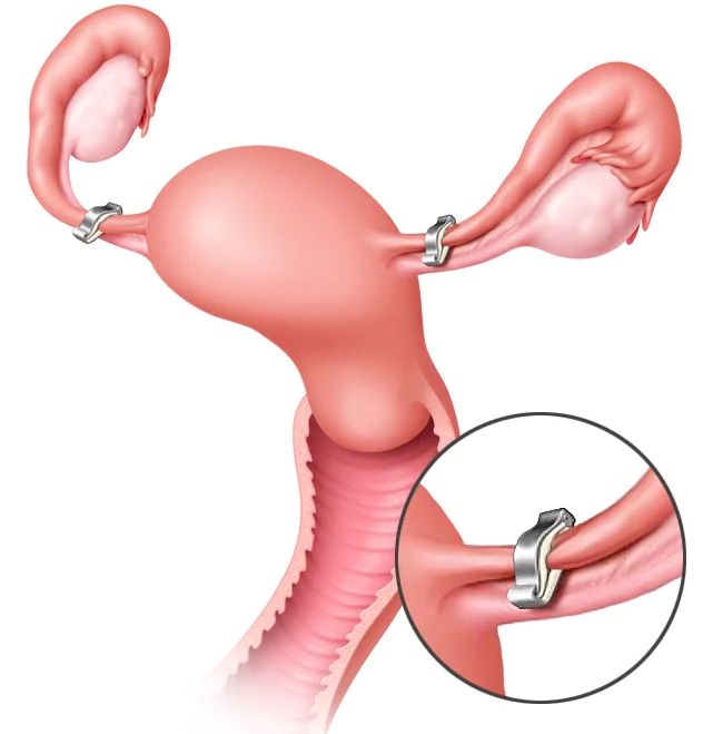 Cirurgia Geral Goiânia - Você sabe o que é laqueadura tubária?