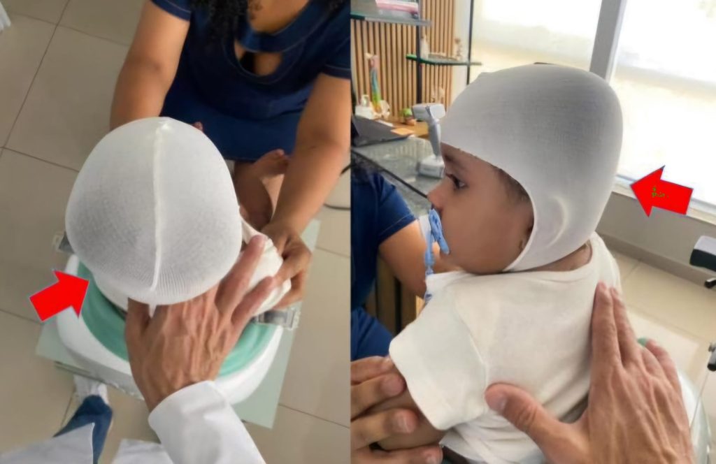 Família de bebê precisa de ajuda para comprar capacete de tratamento que custa R$ 17 mil 1 Imagens de Notícias de Imperatriz