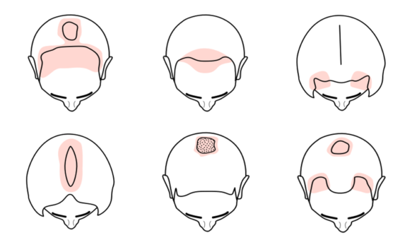 Illustration of different hair loss types.
