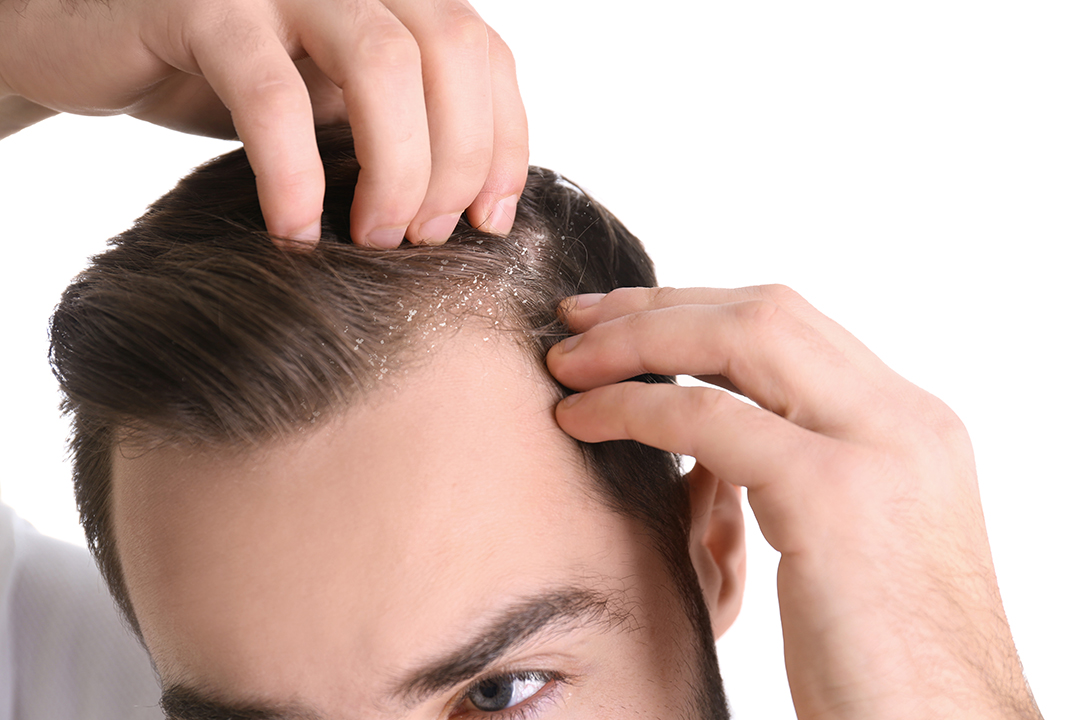 Dandruff vs. Dry Scalp: How to identify the difference? - iRESTORE