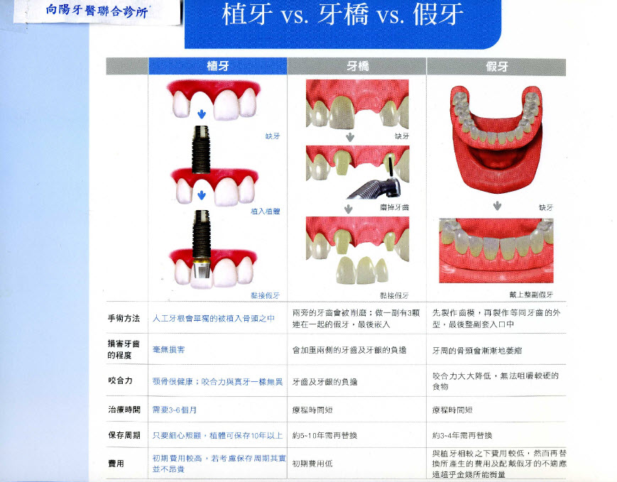 植牙VS牙橋VS假牙