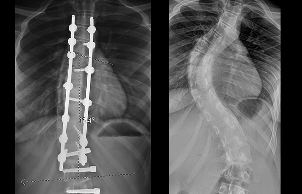 x-rays of a spine