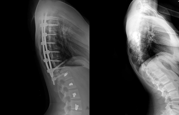 x-rays of a spine