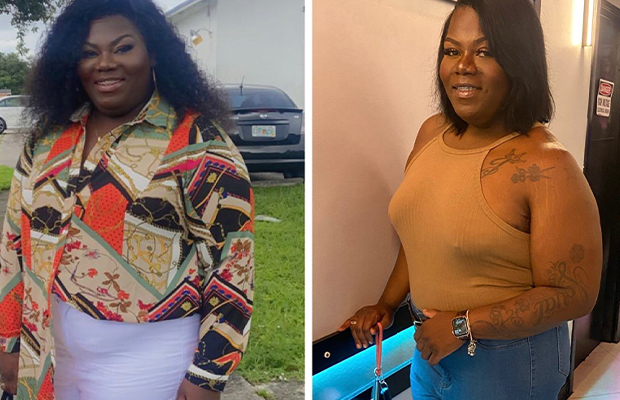 gastric bypass before and after black women