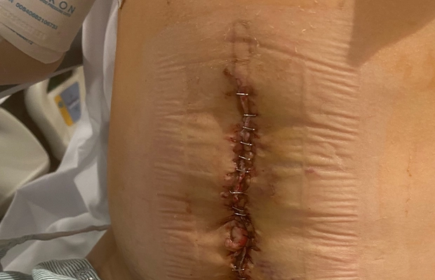 scar on a person's abdomen