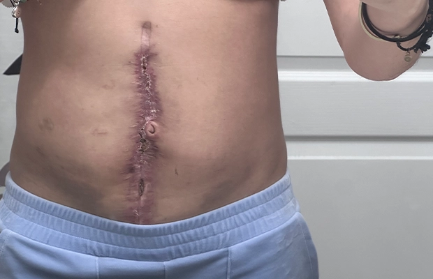 scar on a person's abdomen