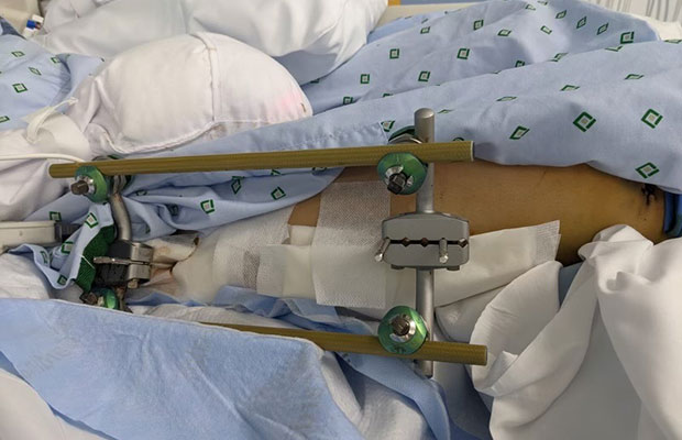 A closeup of a leg with medical devices around it