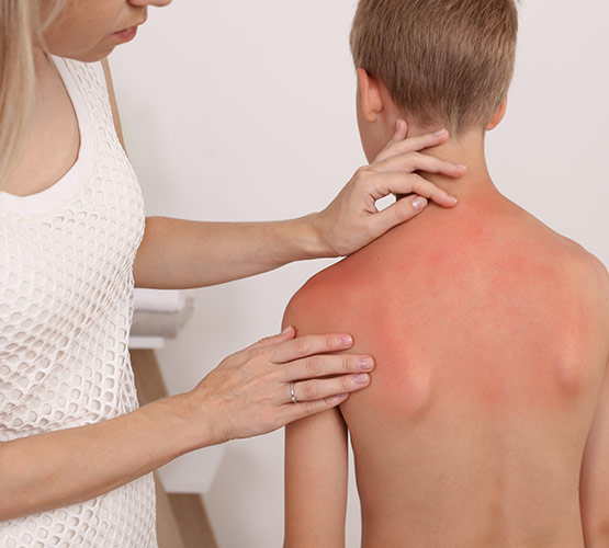 A mom looking at her sons sunburn located on his upper back