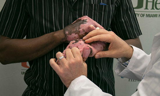 Closeup of a burn patients hands as a doctor checks the patients burn scars