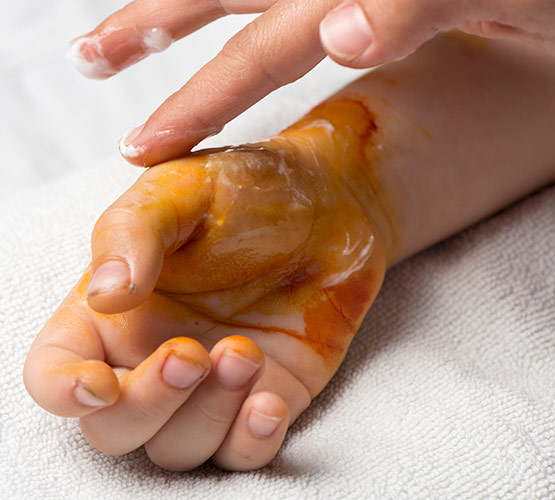 Hand of a child with a second degree burn that is being treated