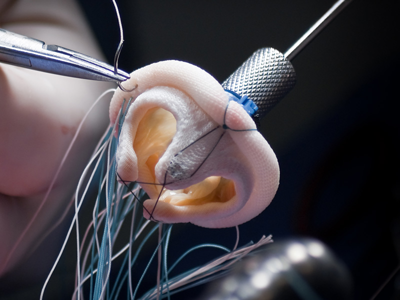 Closeup of a mitral valve replacement heart surgery