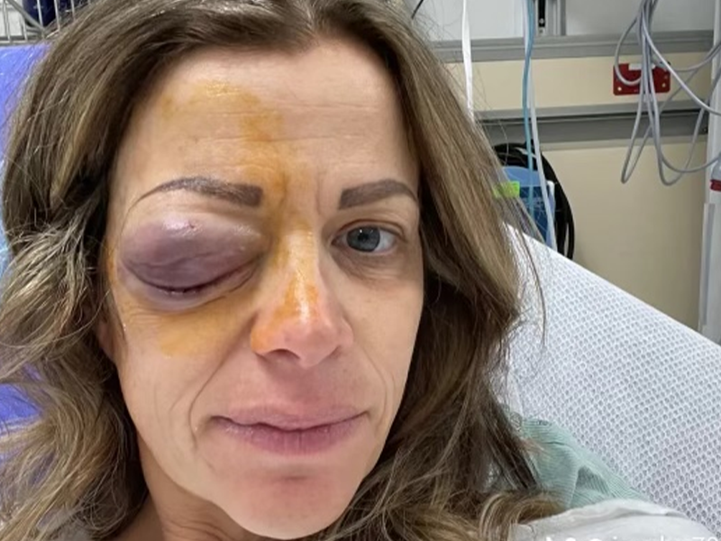 closeup of woman with inflamed eye