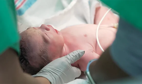 A close-up of a newborn infant receiving immediate postnatal care from medical staff in a delivery room.