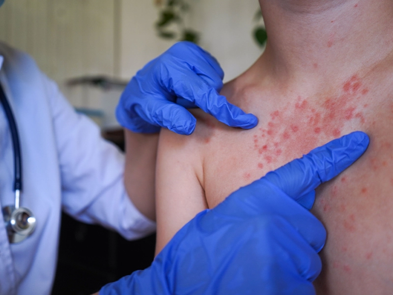 Close-up of a person's shoulder being examined by a doctor because it has red spots.