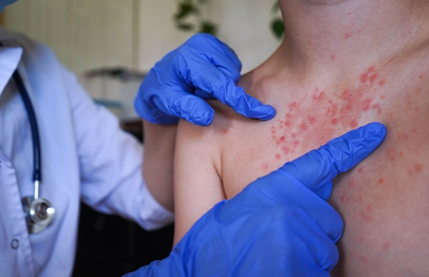 Close-up of a person's shoulder being examined by a doctor because it has red spots.