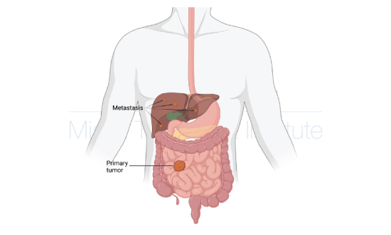 An illustration of a body showing a primary tumor