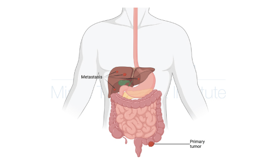 An illustration of a body showing a primary tumor