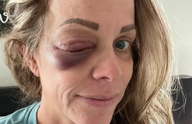 closeup of woman with inflamed eye