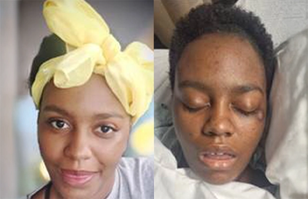 Before and after of a woman after hospitalization