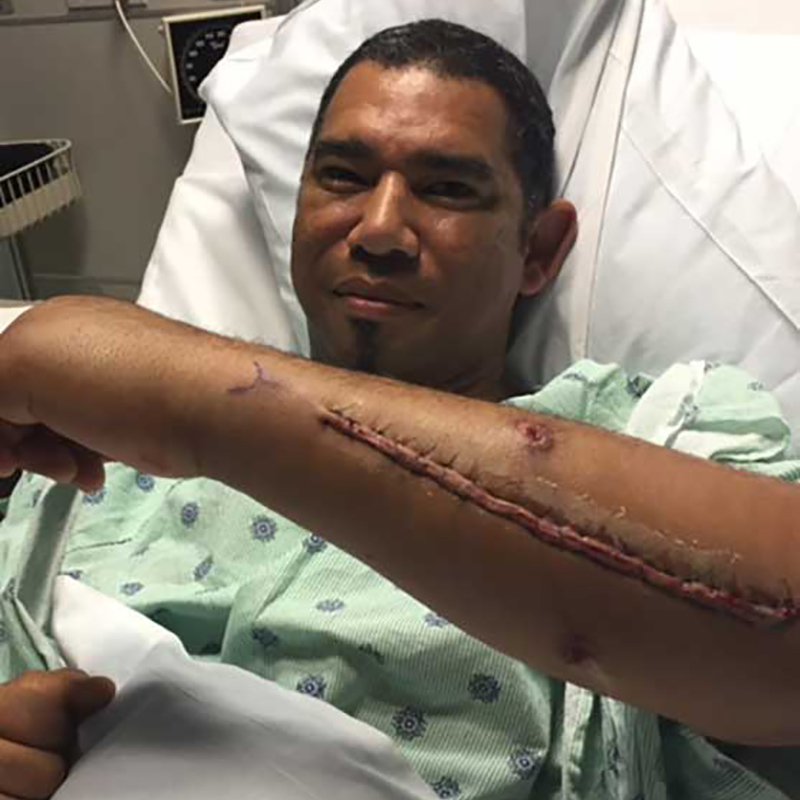 Lino Diaz laying on a hospital bed, his left arm is lifted showing a long scar