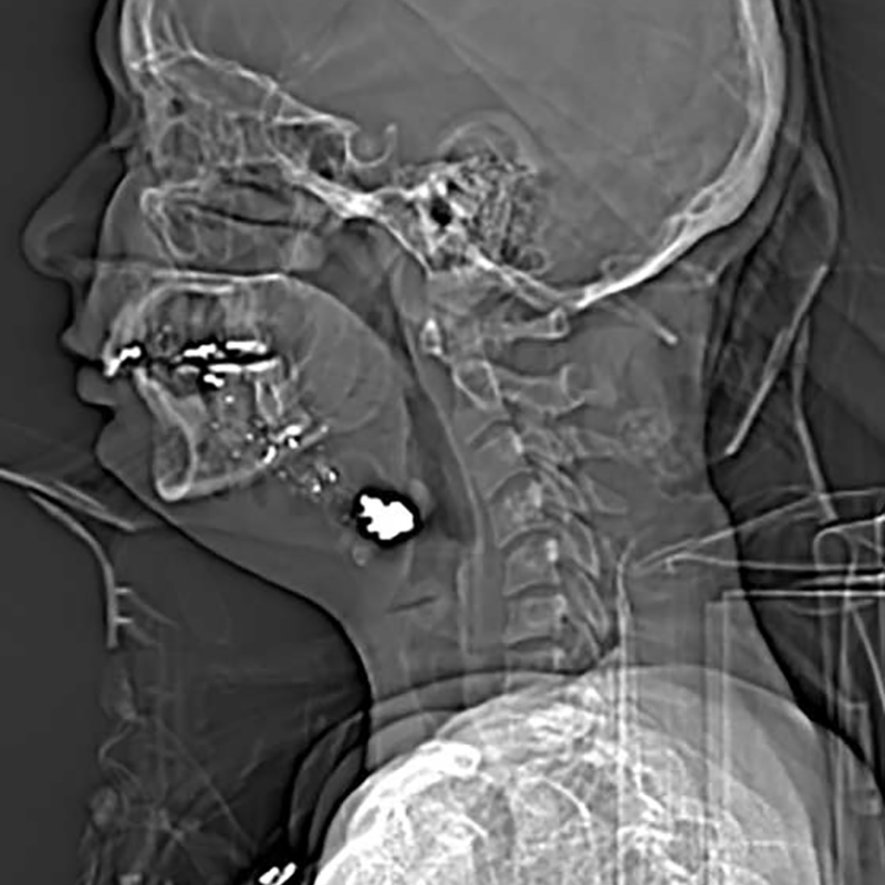 An x-ray of Evelin Matamoros, there is a bullet in her neck