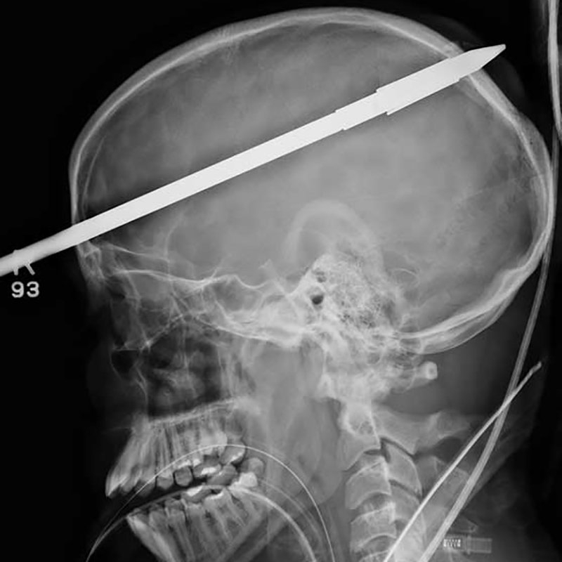 An x-ray of the head of Yasser Lopez, there is a spear going through his head