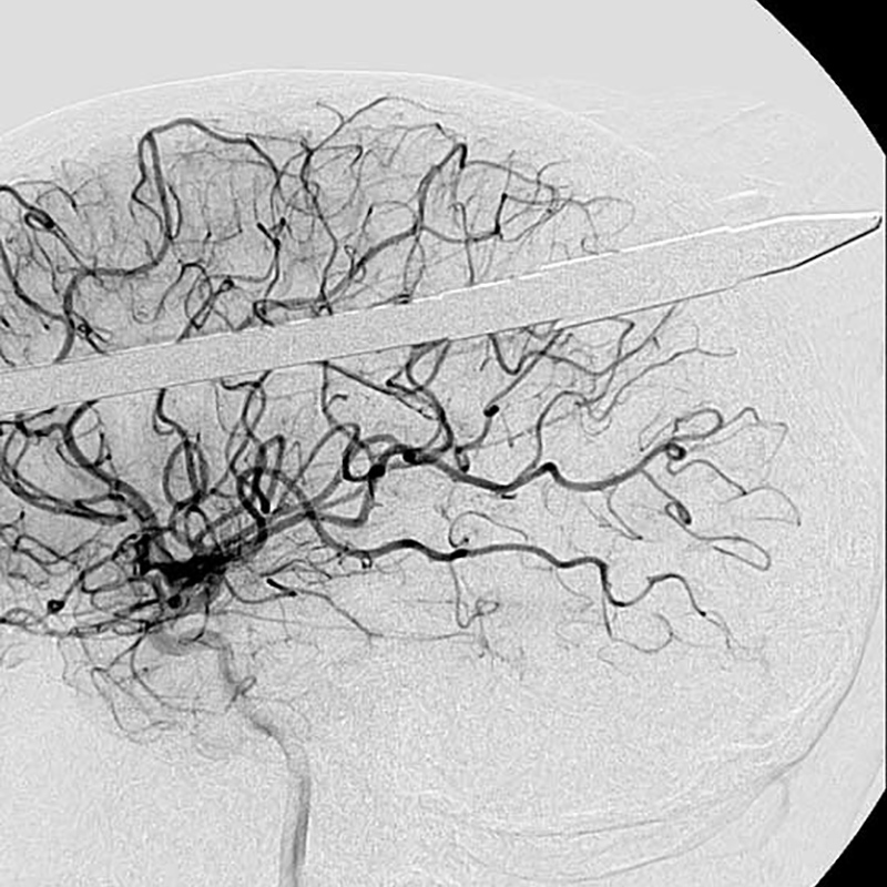 An x-ray of the head of Yasser Lopez, there is a spear going through his head