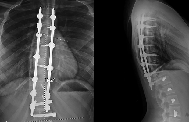 x-rays of a spine