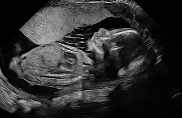 ultrasound