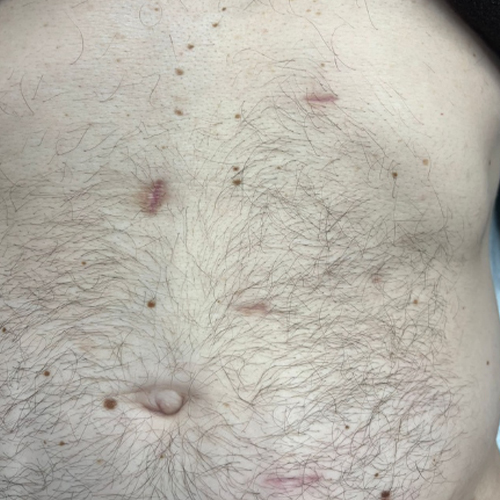 A closeup of a stomach with incision scars