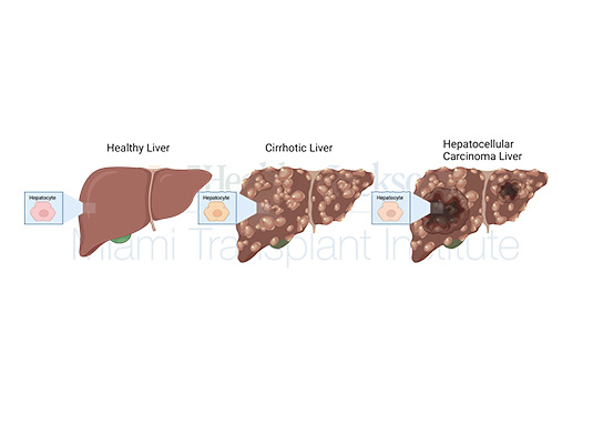 Three images of a liver, from healthy liver, to cirrhotic liver, to hepatocellular carcinoma liver