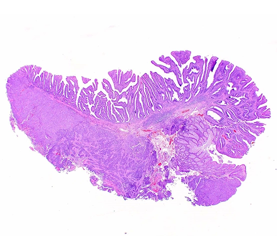 Image of a Voltaggio Tumor color pink