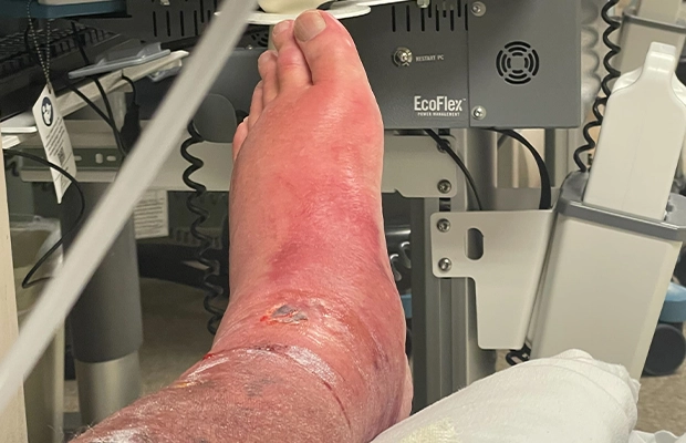 man's foot with wounds