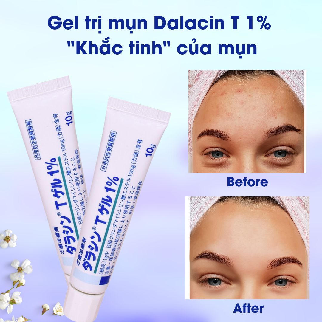 Trị mụn Dalacin T