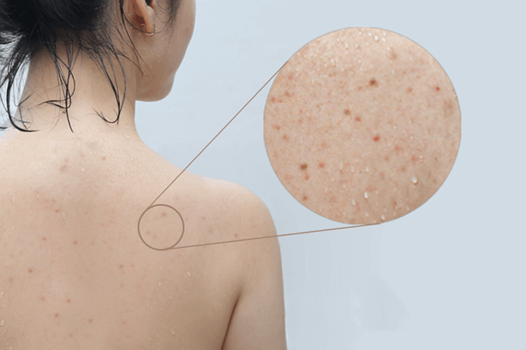 alt-tag review xà phòng trị mụn lưng For Back