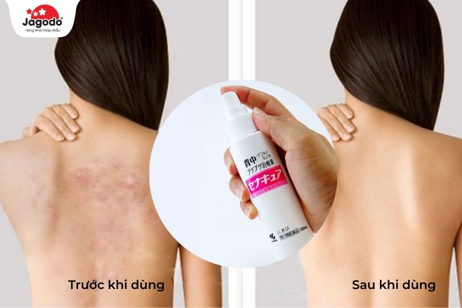 Xịt trị mụn lưng Senakyua Kobayashi