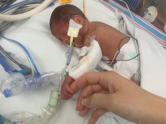 A small baby with tubes coming out of its mouth, it's holding on to a finger