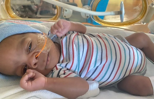 A preterm baby with a feeding tube coming out of its nose, the baby is laying down and looking towards the camera