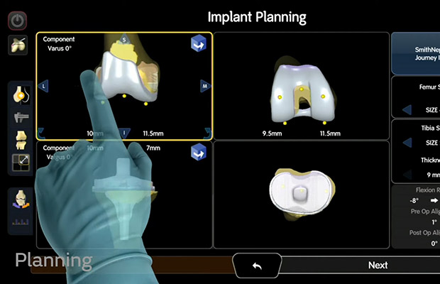 A view of a computer screen that shows different knee views, tibia size, femur size, and implant planning