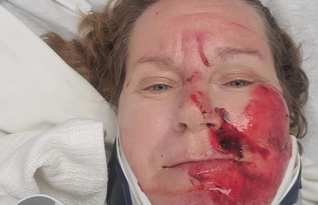 woman with injured face