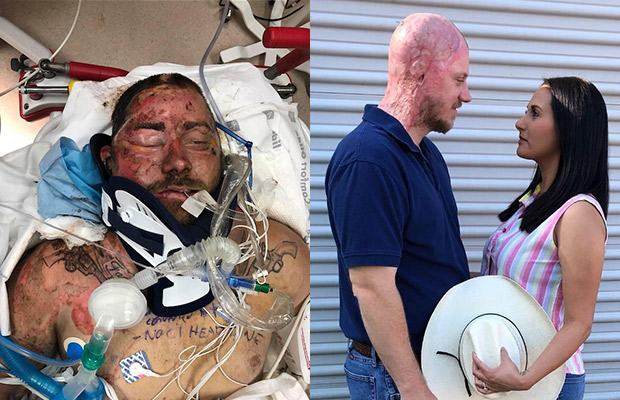 Before and after images. To the left is a man in a hospital bed after an accident. To the right is a closeup of a man with burn scars on his head standing in front of his wife who has long black hair, they are looking at each other