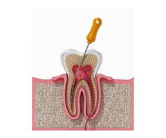 Best Dentist in Mahim East for Root Canal at Smile Again Dental Clinic