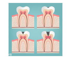 Best Dentist in Mahim East for Root Canal at Smile Again Dental Clinic - Image 3
